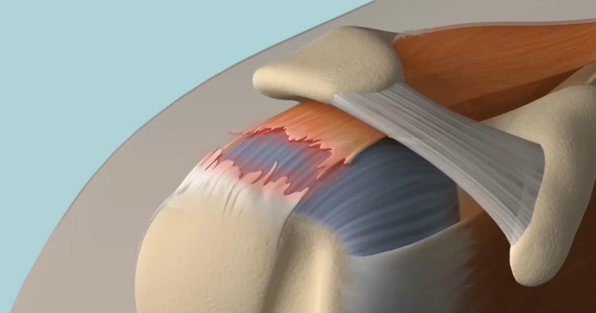 Rotator Cuff Tears, Evaluation And Treatment A Critical Review